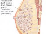 Pseudoknoten