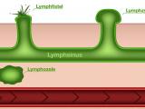 Ödemkomplikationen (Manuelle Lymphdrainage)